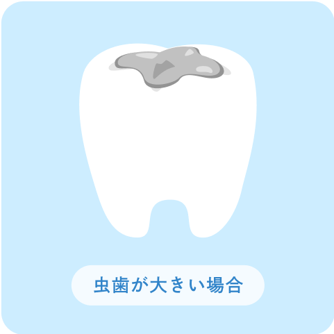 インレー(詰め物)