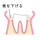 クラウンレングスニング