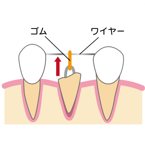 エクストリュージョン