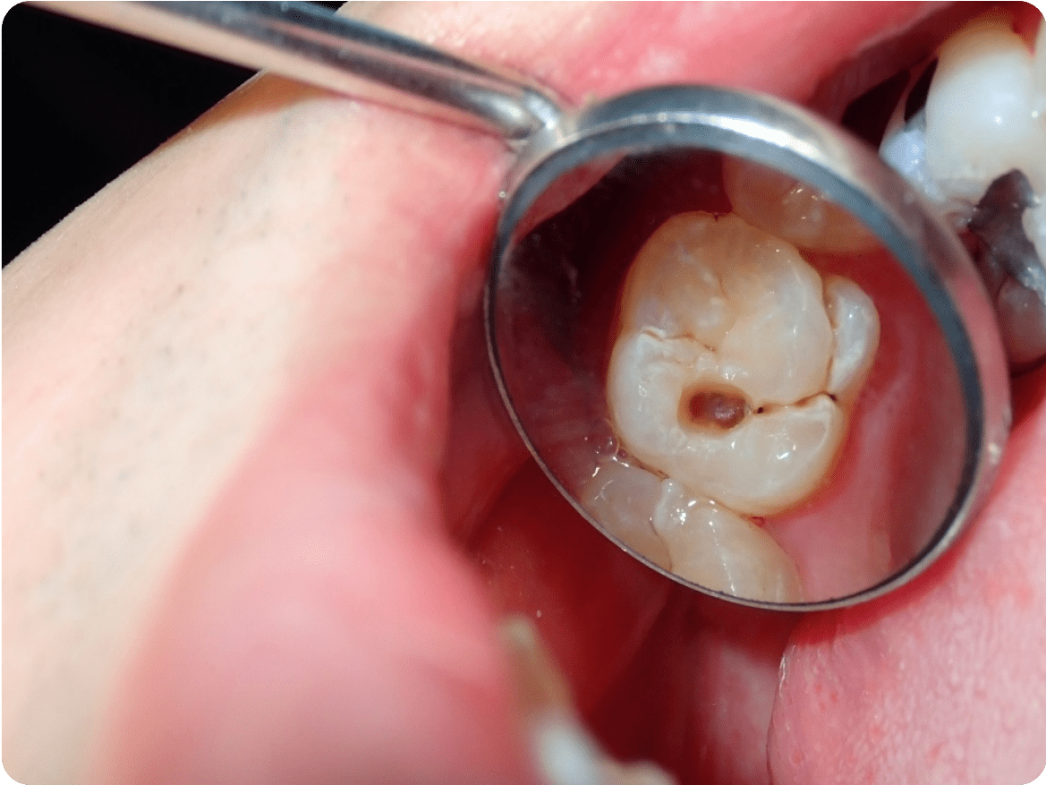 お子さまの痛みを最小限に!怖くない虫歯治療の工夫