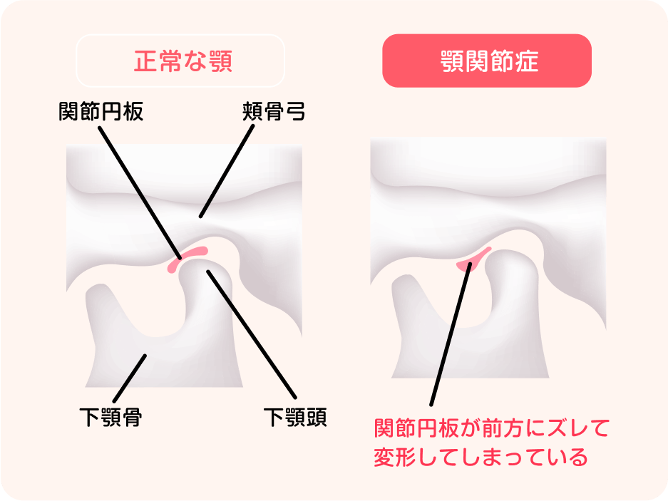 ボツリヌス治療で「顎の痛み」も改善されます