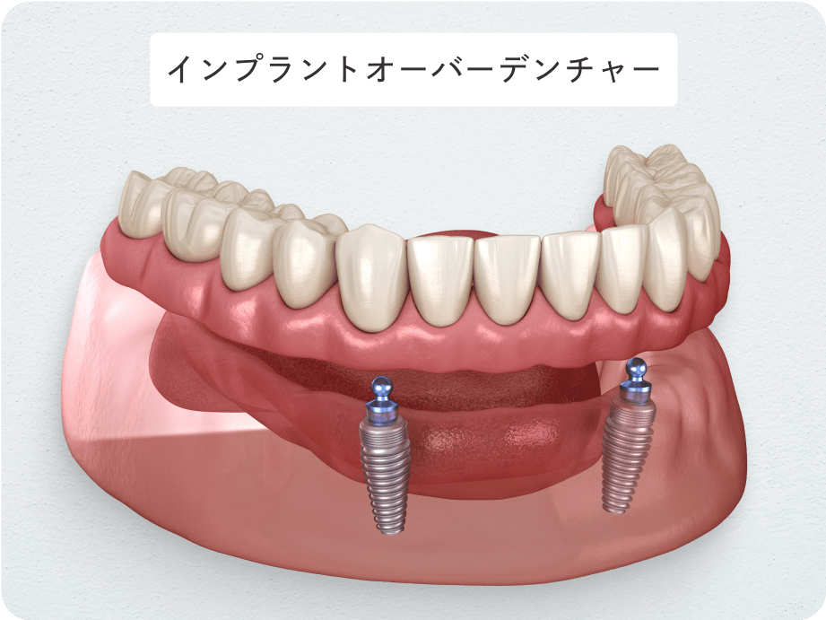 インプラントオーバーデンチャー
