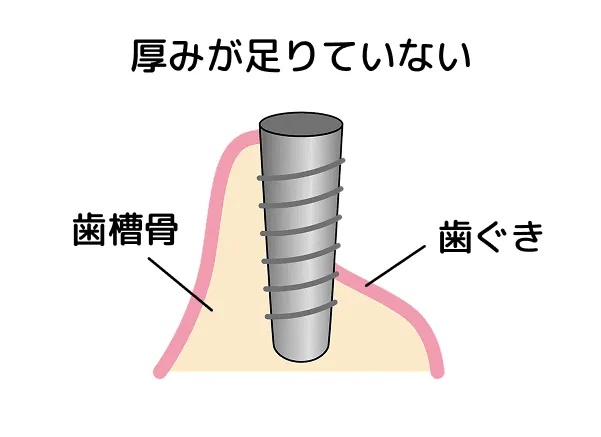 骨が足らず、インプラントが安定していません