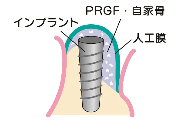 PRGF・自家骨と人工膜で再生を促す