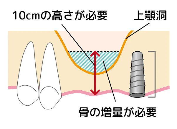 骨が足らないので、増量を行います