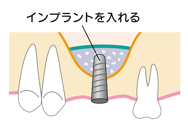 再生した骨にインプラントを埋め込む