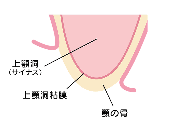 骨が足りず、インプラントが入れられない状態