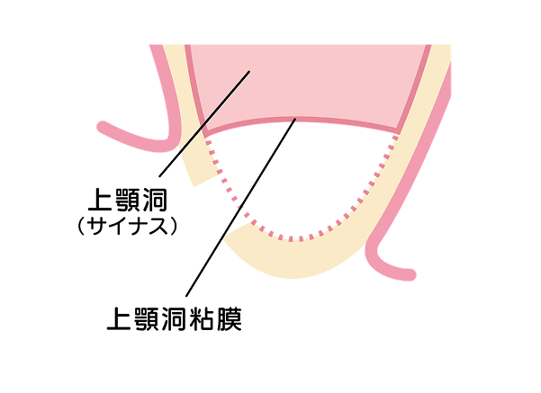 上顎洞の底に人工的なスペースを作る