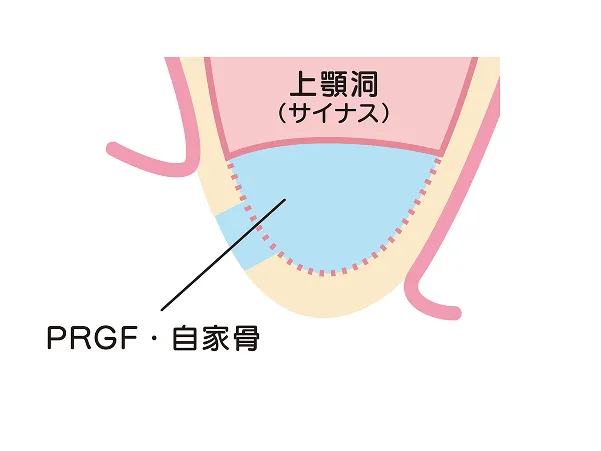 空間に代用骨を入れて、骨の土台を再生