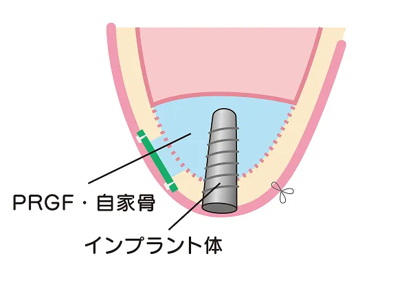 十分な骨ができた後にインプラントを埋入