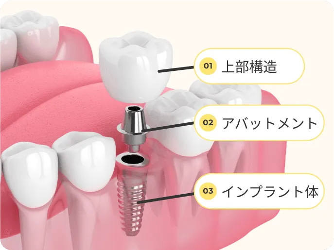 インプラントってどんな構造なの?