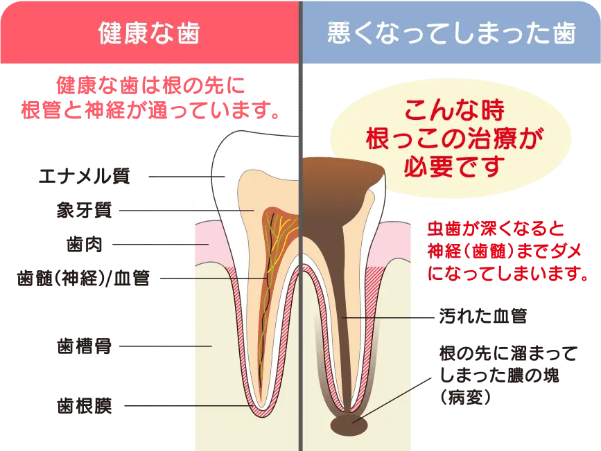 歯根挺出術（エクストリュージョン）