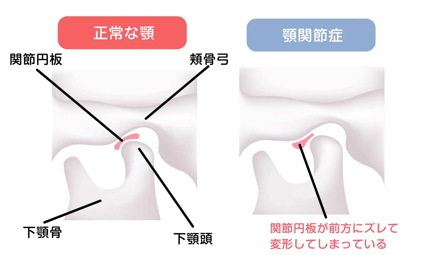 顎関節症治療