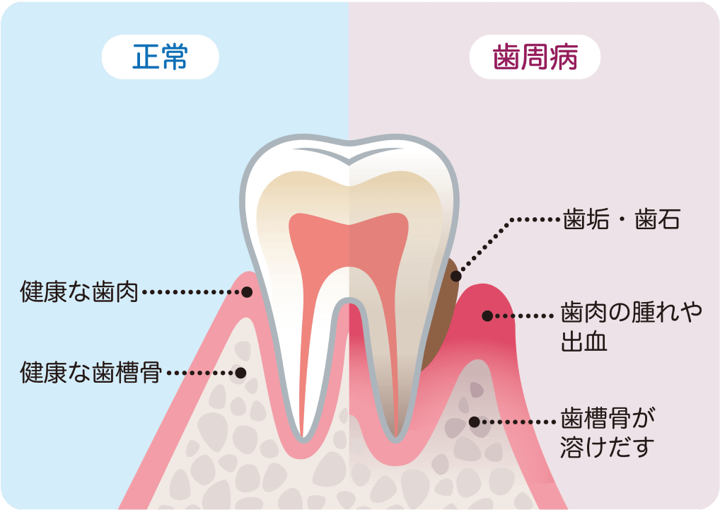 どうして歯周病になるの?