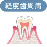 軽度歯周病
