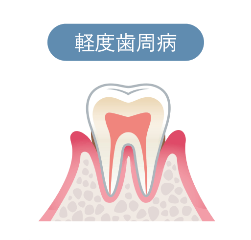 軽度歯周病