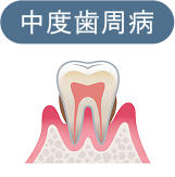 中度歯周病