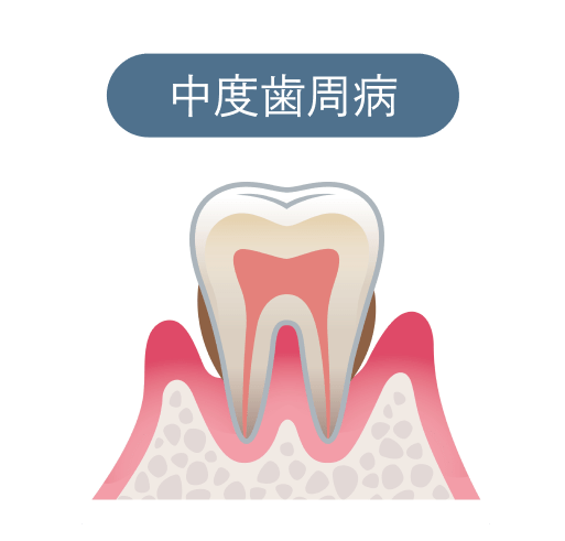 中度歯周病