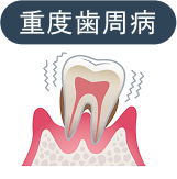 重度歯周病