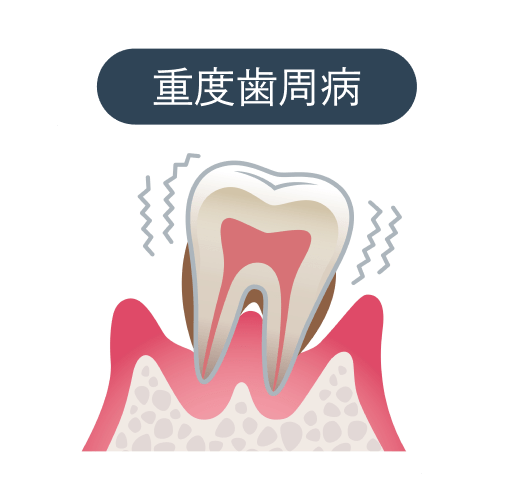 重度歯周病