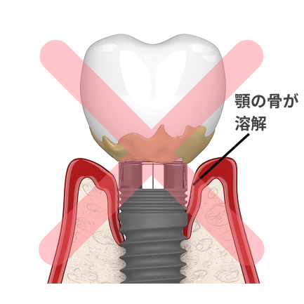 インプラント周囲炎