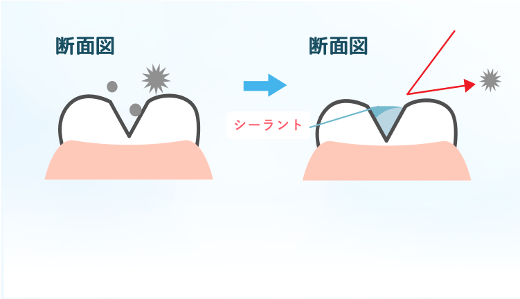 奥歯の溝を保護し、虫歯を予防するために「シーラント」を実施