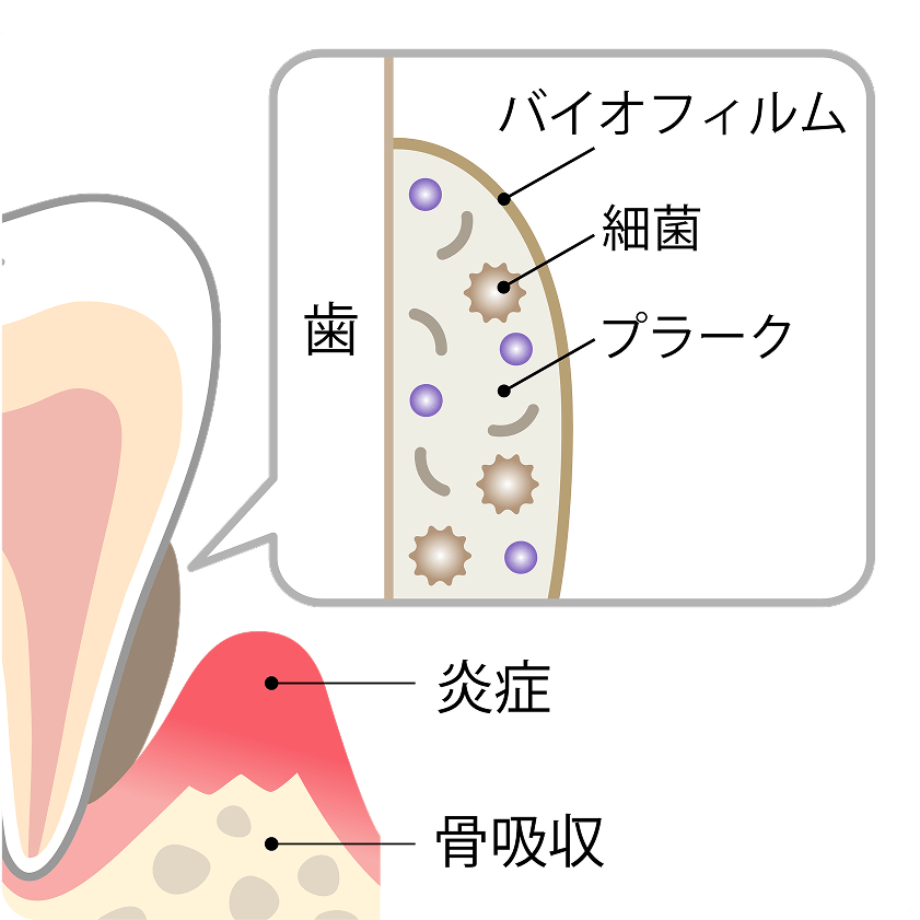 プラーク(歯垢)ってなに?