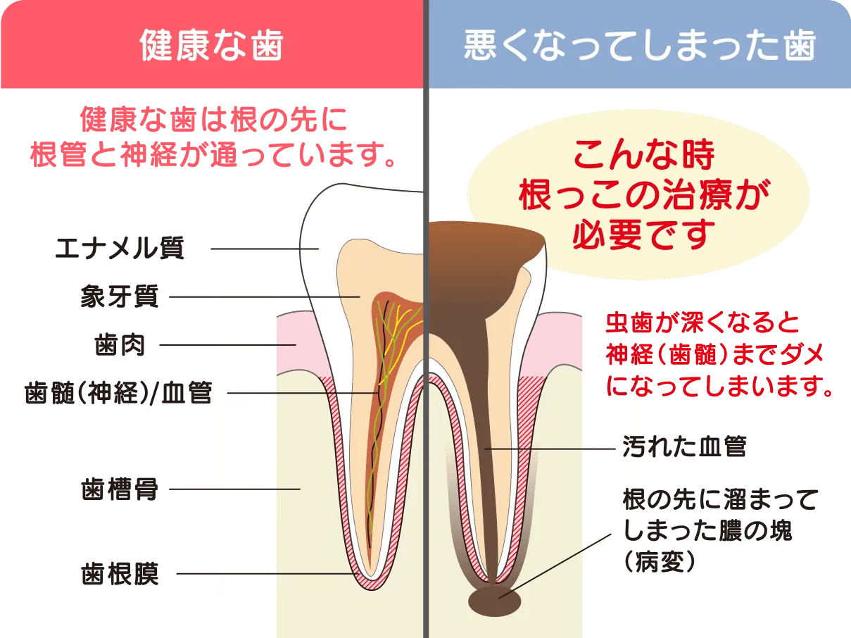 根管治療ってなに?
