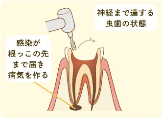 虫歯と古い人工物の除去