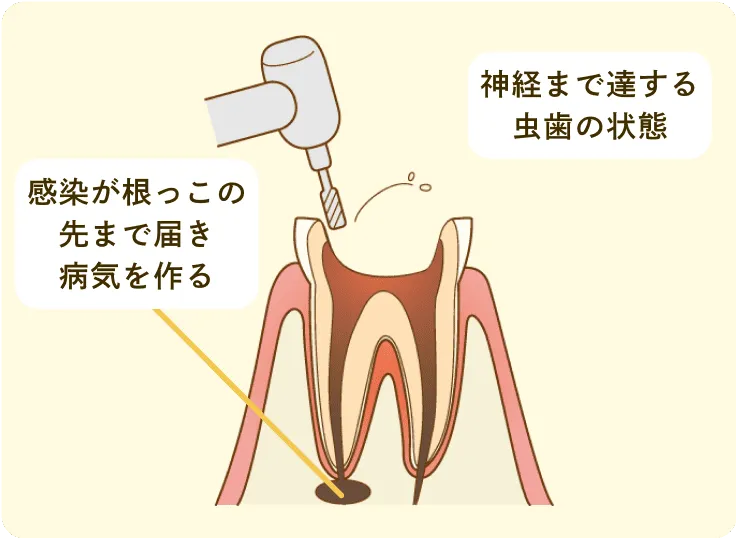虫歯と古い人工物の除去