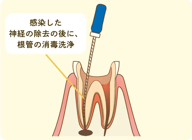 感染部分の徹底クリーニング