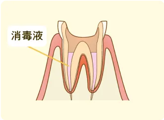 根管内の洗浄・消毒と密閉処理
