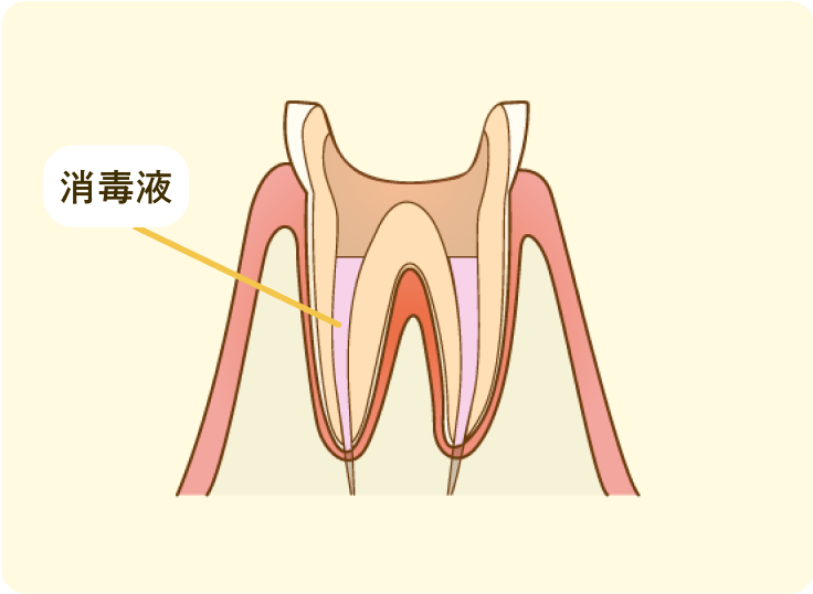根管内の洗浄・消毒と密閉処理