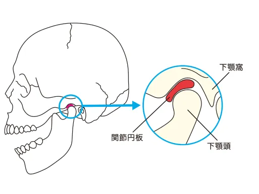 顎関節症